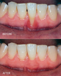 before and after gum recession treatment