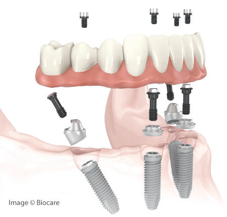 dental implants all-on-4