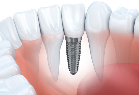 dental implant