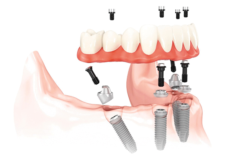 Teeth in One Day with All-on-4 diagram