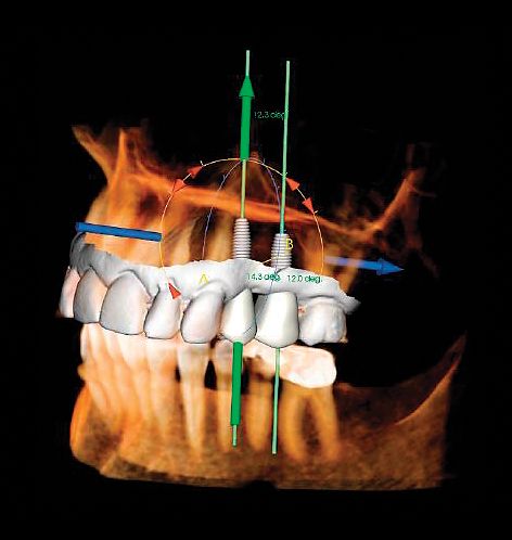 dental implants diagram Aurora IL