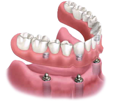 implant supported snap in dentures