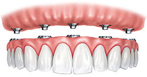 fixed-in implant-supported teeth