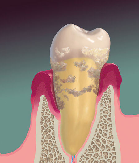 signs of gum disease
